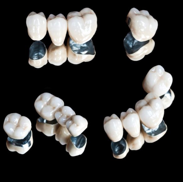 a complete guide to dental bridges